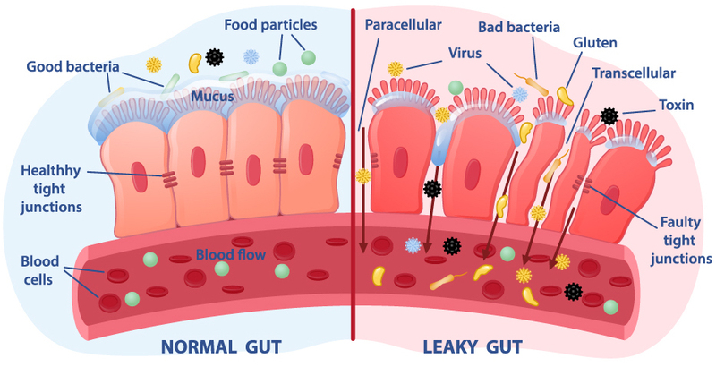 Leaky Gut Syndrome